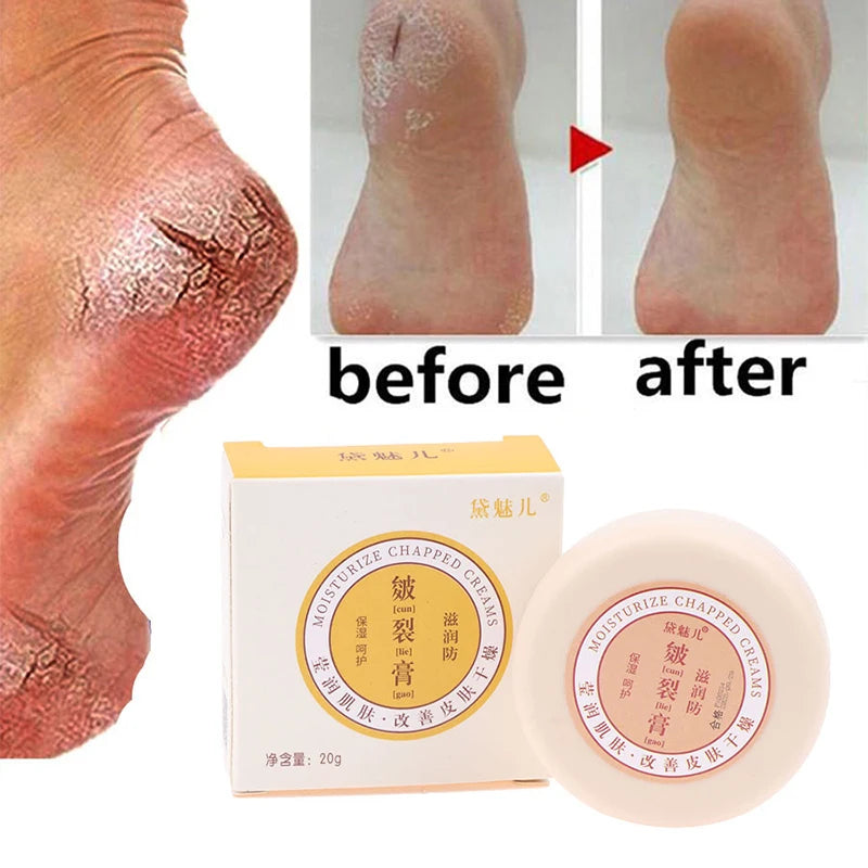 Before and after image of callus remover cream for dry cracked feet and heels, showcasing moisturizing effects.