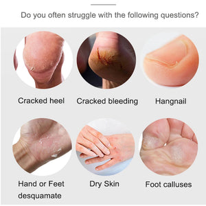 Collage of hand and foot problems: cracked heel, bleeding, hangnail, dry skin, and calluses.