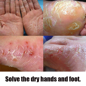 Images showing dry, cracked hands and feet, highlighting the need for effective moisturizing care.